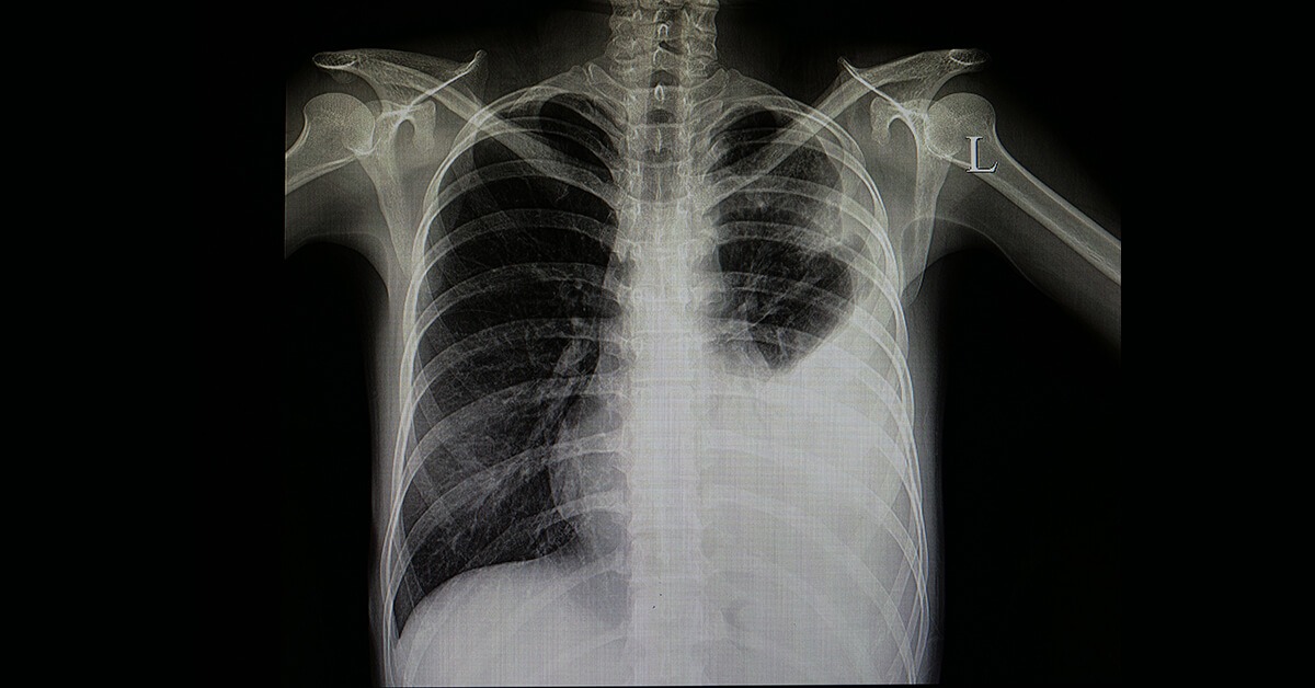 image of a chest x-ray with one lung being partly white