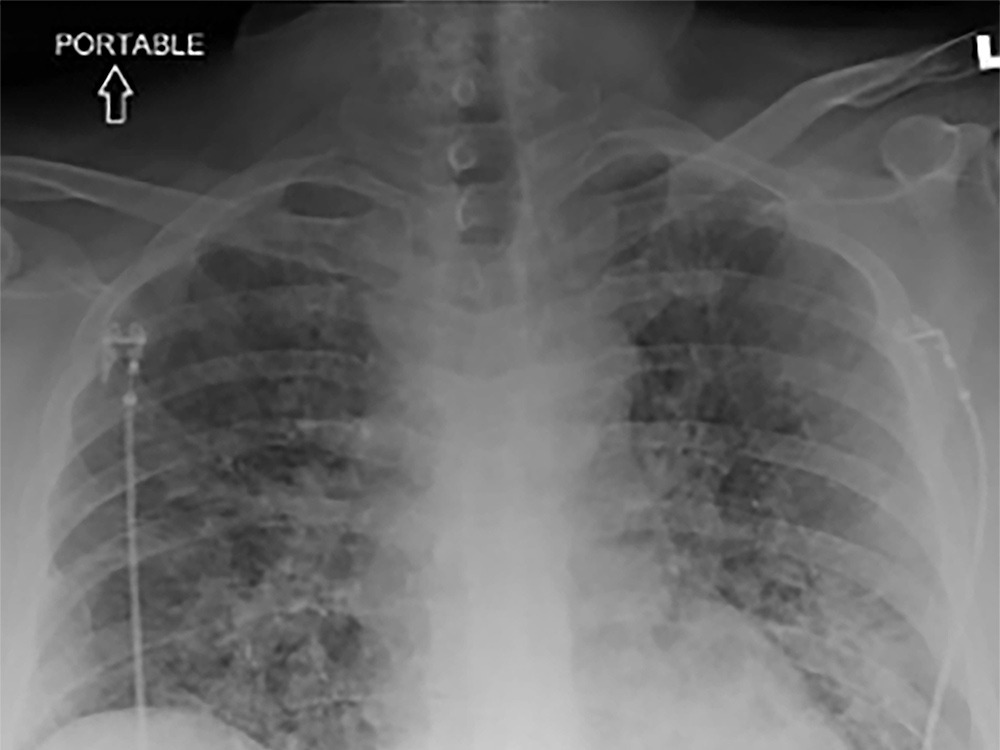 Image of a chest x-ray showing grayness in the lungs